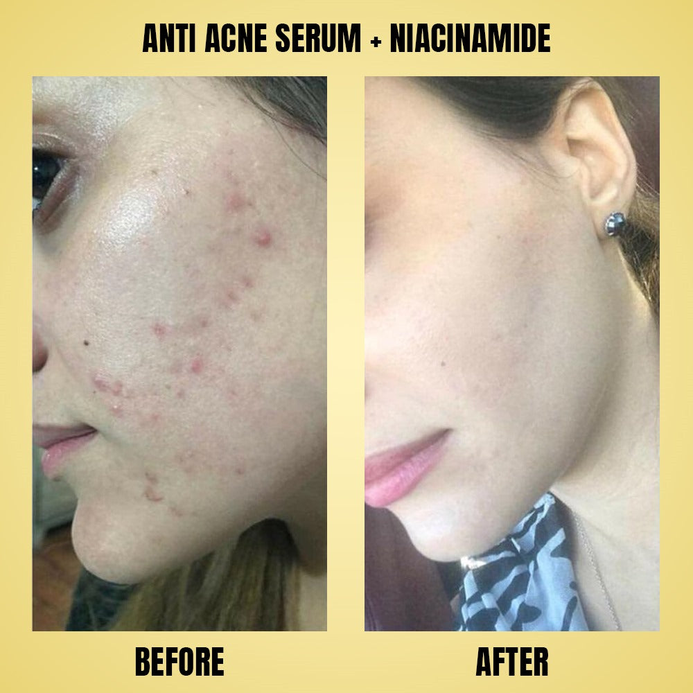 Anti Acne Serum + Niacinamide Arwa Skin Care